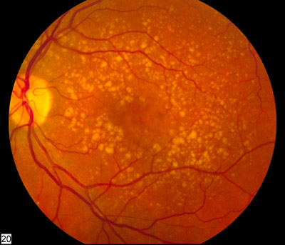 Added-benefit-of-faricimab-for-macular-degeneration-not-proven-by.jpg