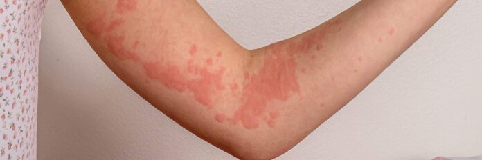 Hives-What-they-look-like-possible-causes-and-treatments.jpg